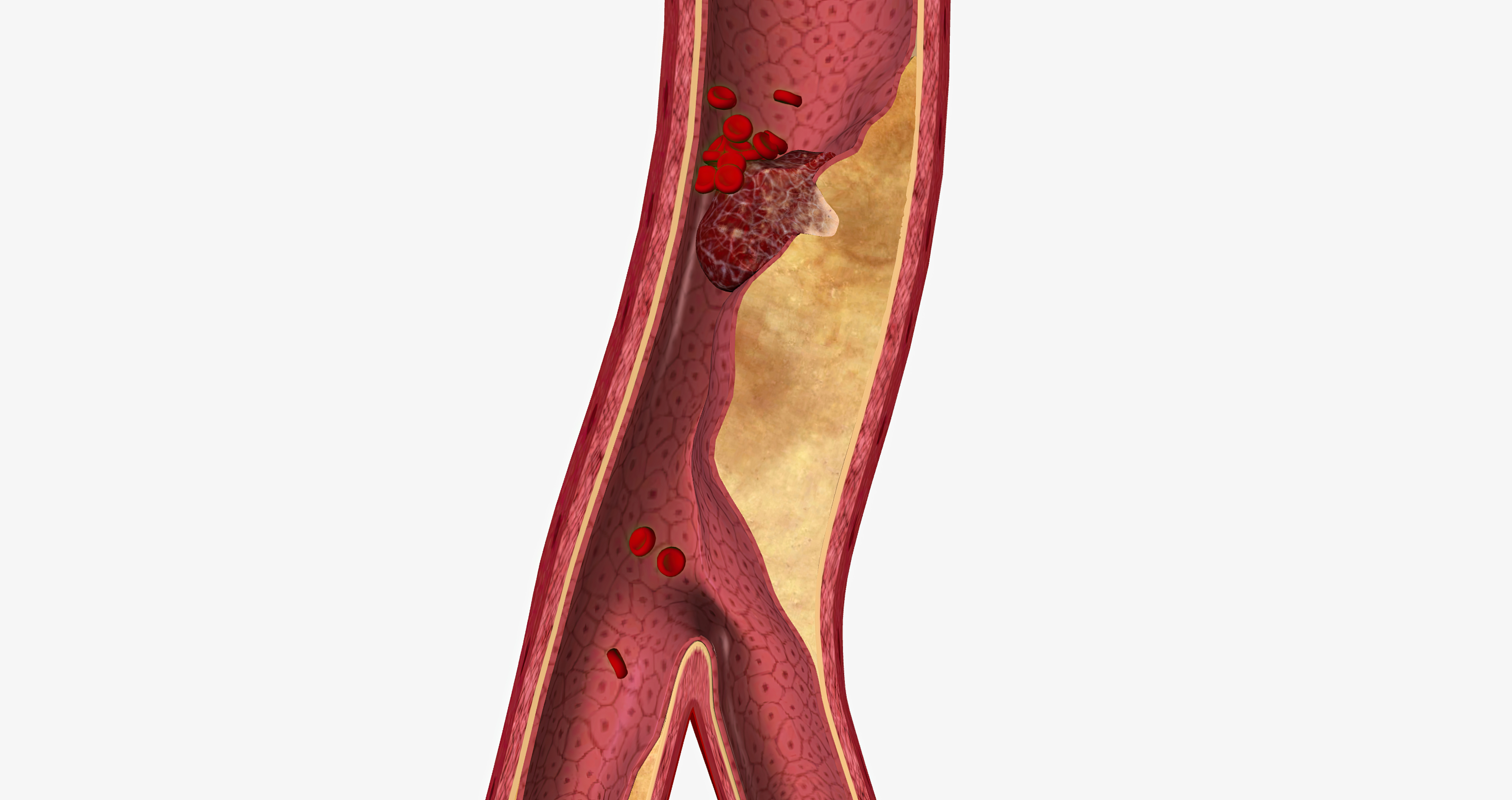 Resveratrol กับการป้องกันเส้นเลือดตีบ
